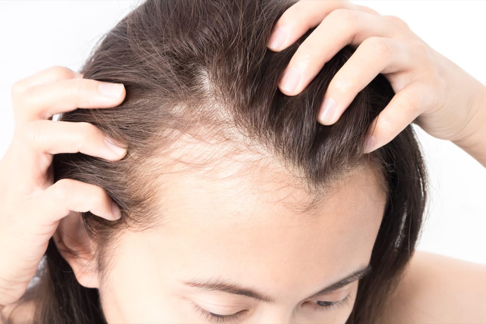 PRP hair restoration