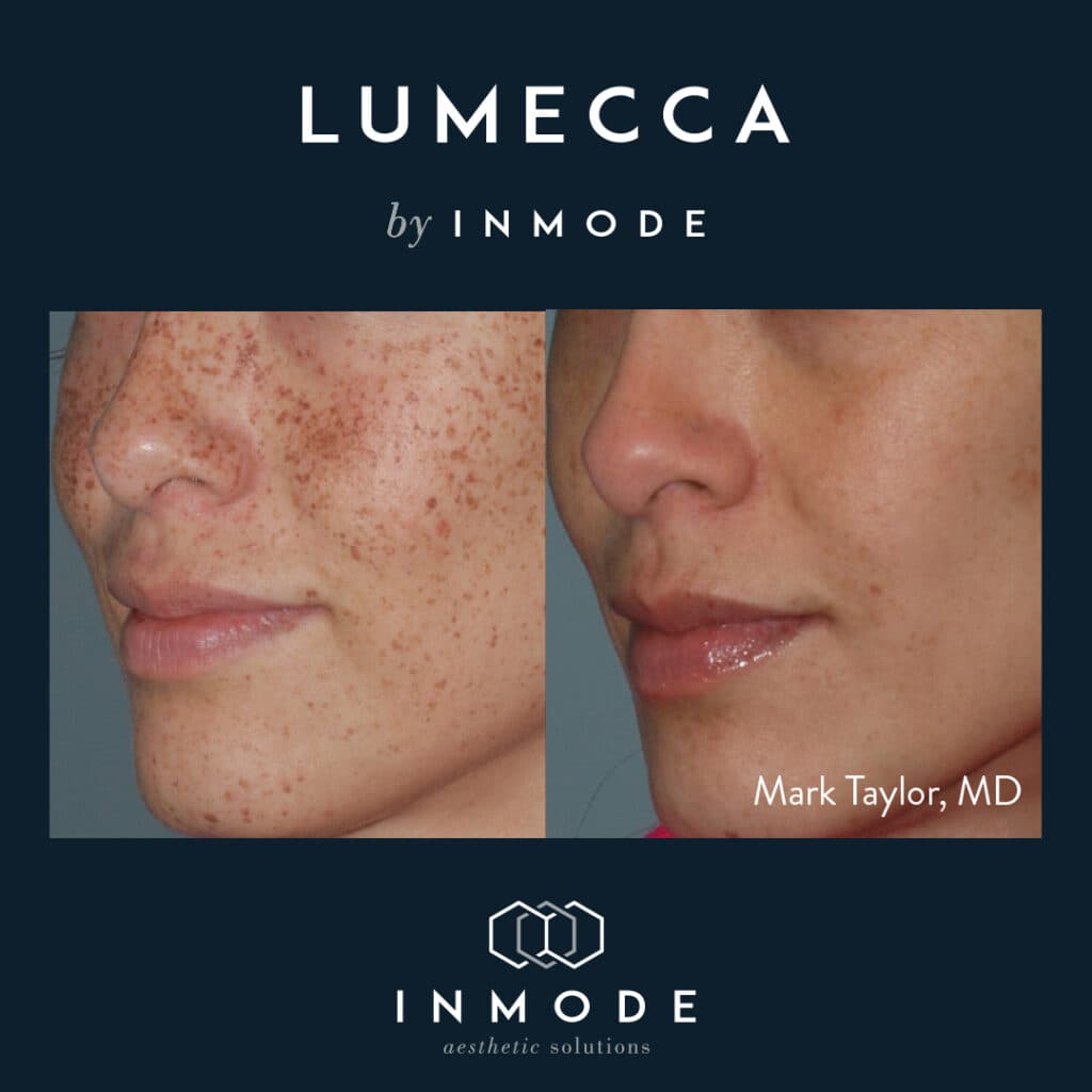 Lumecca IPL photofacial