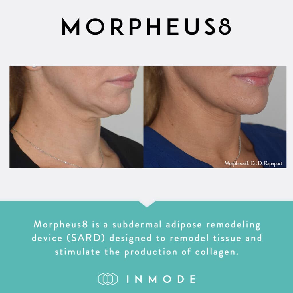 Morpheus8 before and after